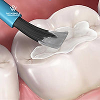Hàn trám răng bằng Composite | Nha Khoa Win Smile