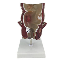 Anatomical Human Rectum Fissure Lesion Model Teaching Instruments Anatomy