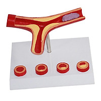 Human Vessel Anatomical Model Atherosclerosis Model For Training Model