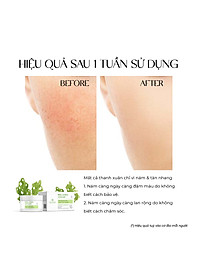 Kem nám và tàn nhang ban đêm Truesky Melasma Cream chiết xuất tảo biển 20g