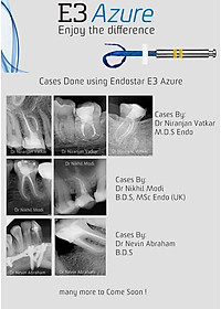 Trâm file nội nha từ châu Âu EndoStar E3 Azure-file dẻo