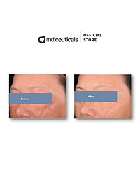 MD:TRANEX RETIPEEL – THAY DA SINH HỌC HỖ TRỢ TRỊ NÁM, SÁNG DA &amp; CHỐNG LÃO HÓA