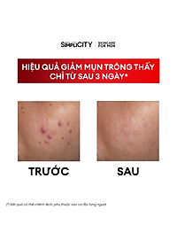 Bộ đôi giảm mụn sưng viêm Men Stay Simplicity cho nam Zinc PCA 1% + Terpineol-4 100g + 30ml