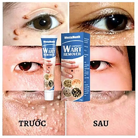 HỘP KEM BÔI TRỊ HẾT MỤN CÓC NÚT RUỒI MỤN THỊT HÀNG CHUẨN 