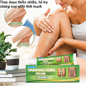 Mua Kem thảo dược thiên nhiên chống suy giãn tĩnh mạch  bôi hàng ngày  tặng kèm vòng tay thể thao Luminous