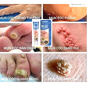 Mua KEM TẨY XÓA MỤN CÓC MỤN THỊT CỰC NHANH CAM KẾT HIỆU QUẢ HÀNG LOẠI TỐT