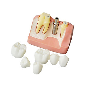 Implant Analysis Bridge Demonstration Teeth Teach Model