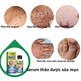 Mua Serum da liễu bôi mụn thịt  mụn cơm  mụn cóc  nốt ruồi  thành phần thảo dược an toàn giá rẻ_HBESTY