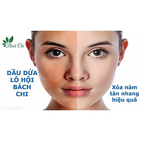 Dầu dừa lô hội Bách Chi - Xóa nám, tàn nhang hiệu quả