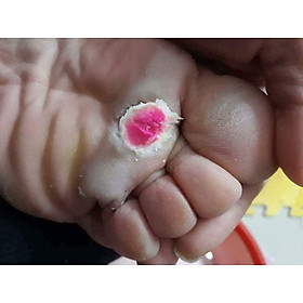 MIẾNG DÁN MỤN CÓC PLASTERS / mụn thịt