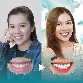 Điều trị dứt điểm hở lợi tại Nha Khoa Thẩm Mỹ Quốc Tế San Dentist