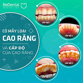 Lấy Cao Răng (Cạo vôi răng) Và Đánh Bóng Công Nghệ Siêu Âm Mới - Nha khoa BeDental (5 chi nhánh)