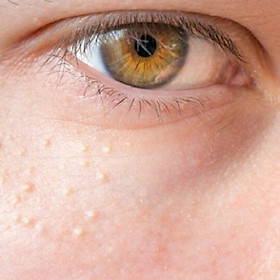 Điều Trị Mụn Thịt