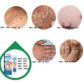 Mua Kem da liễu bôi mụn thịt  mụn cơm  mụn cóc  nốt ruồi  thành phần thảo dược an toàn giá rẻ_HBESTY