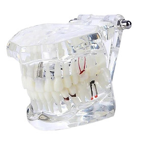 1pc Transparent Dental Study Teeth Model with Nerve Repair Demonstration