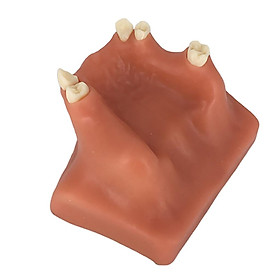 Upper Jaw Sinus Lift Implants Restoration Tooth Practice Model