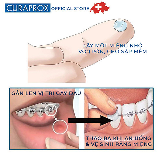 Bộ chăm sóc răng niềng curaprox ortho kit màu sắc bàn chải bất kỳ - ảnh sản phẩm 5