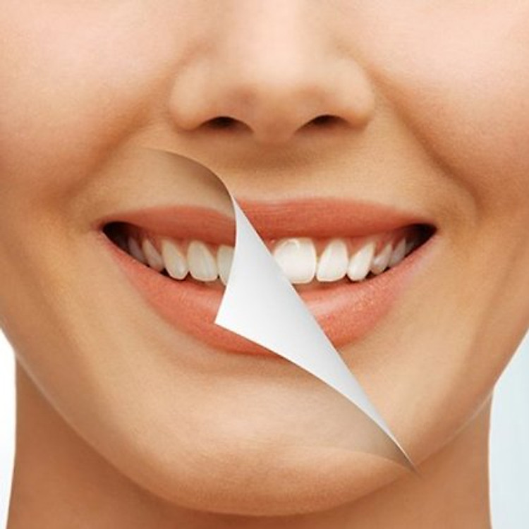 Lấy Cao Răng, Đánh Bóng & Hàn 01 Răng Tại Nha khoa VIPLAB