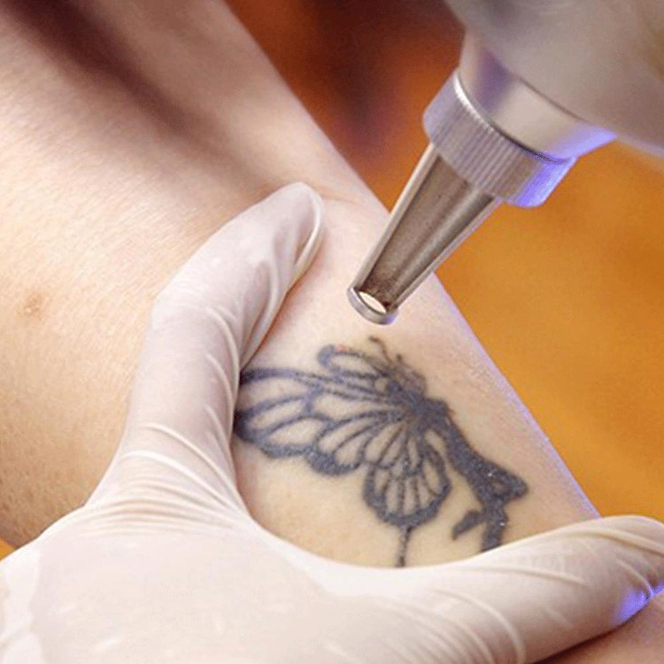 XÓA XĂM THẨM MỸ VỚI LASER MAQX HOA KỲ