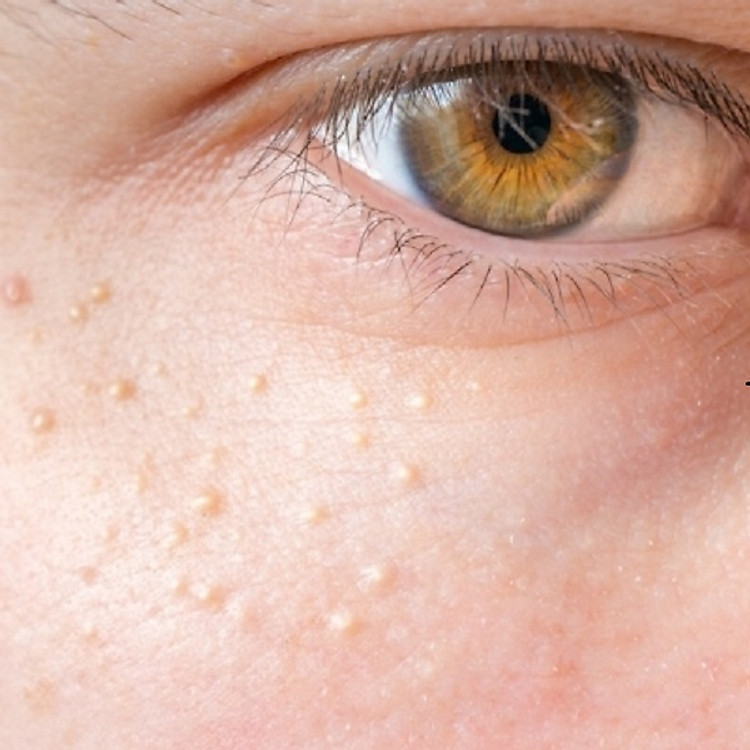 Đốt nốt ruồi, mụn thịt: Hiệu quả sau 1 – 2 lần điều trị