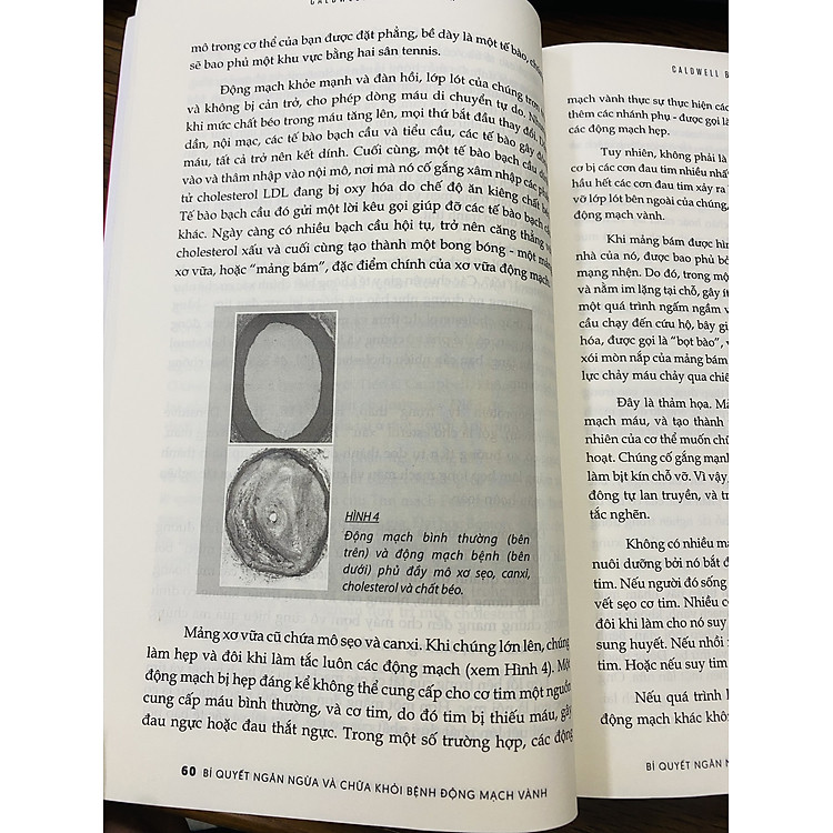 Bí Quyết Ngăn Ngừa Và Chữa Khỏi Bệnh Động Mạch Vành - Ảnh 6