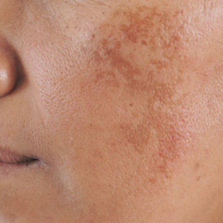 Trị nám bằng phương pháp Peeling Selvert Thuỵ Sĩ