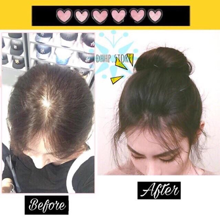 Tóc giả kẹp mái phồng che hói