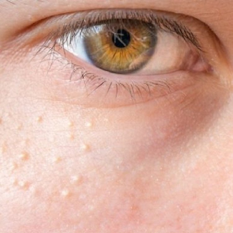 Điều Trị Mụn Thịt