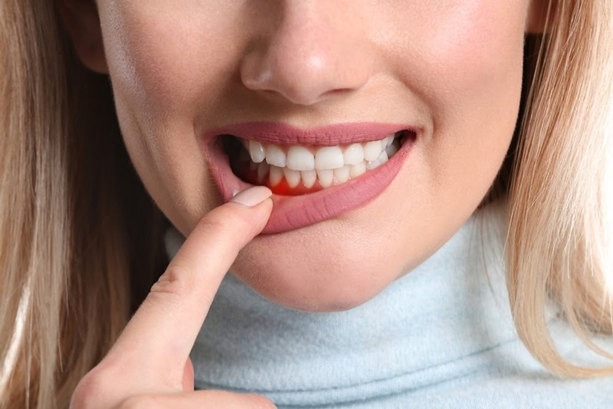 Cho máy Oral B Braun, bộ 4 Đầu Bàn Chải đánh răng điện thay thế MIHOCO EB60-P New Gum Care, sợi cước siêu mềm, cho răng lợi nhạy cảm