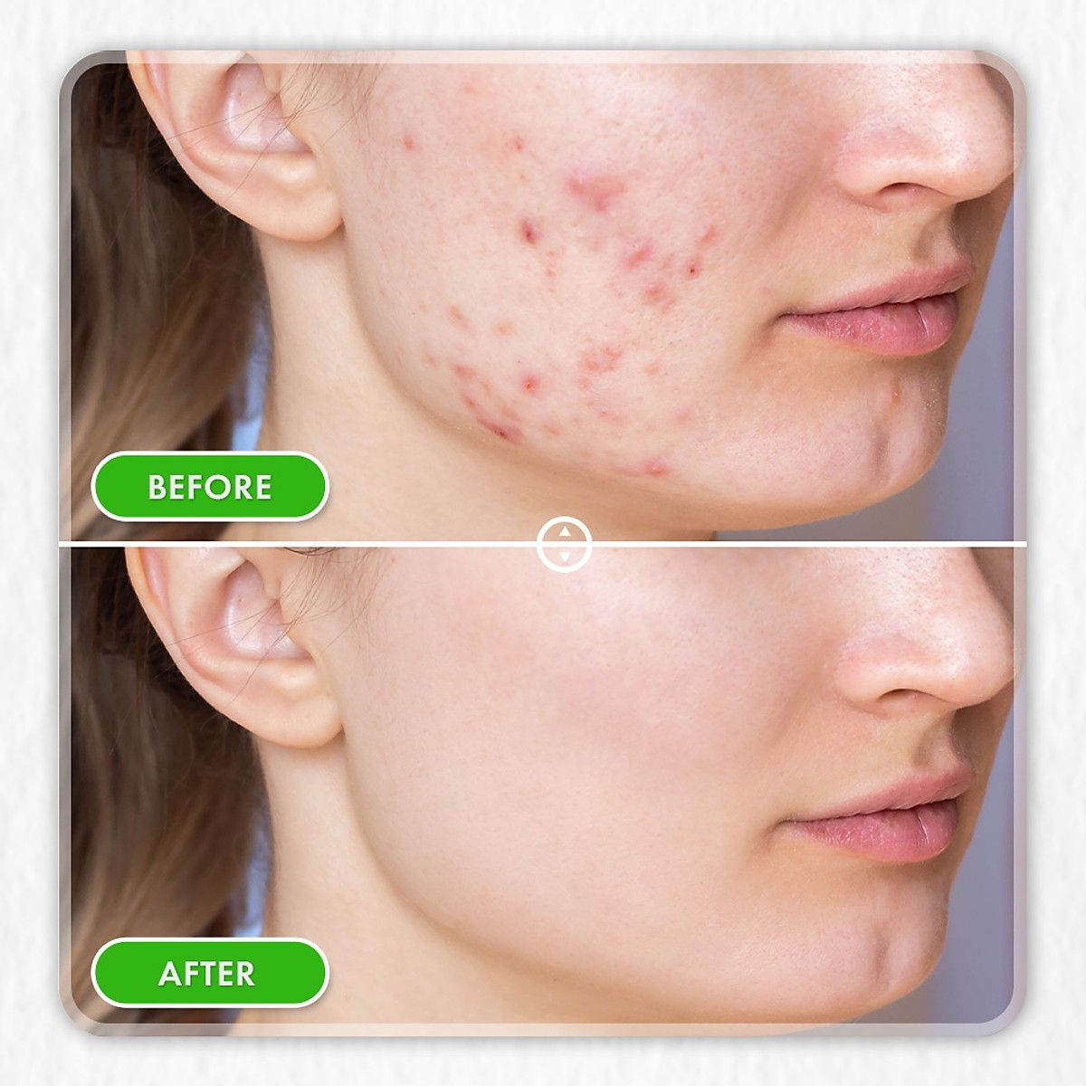 Combo 2 kem chấm mụn Oribe giảm mụn ẩn mờ thâm liền sẹo 20g