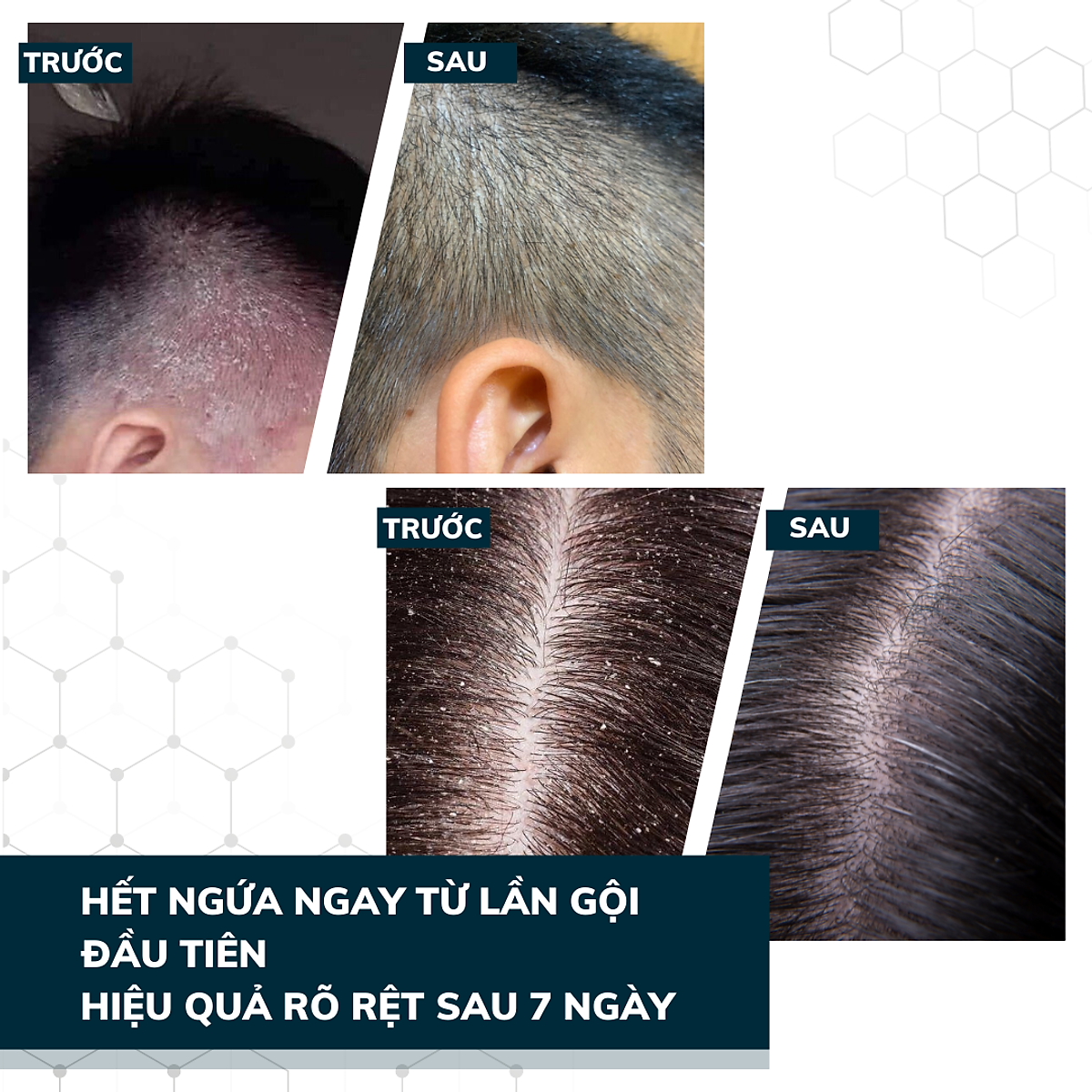 Dego Pharma - Dầu gội sạch vảy gàu mảng trắng, hết ngứa chiết xuất thiên nhiên từ vỏ cây Zizyphus, sản xuất theo tiêu chuẩn và dưới sự giám sát của công ty dược phẩm Châu Âu (80ml)