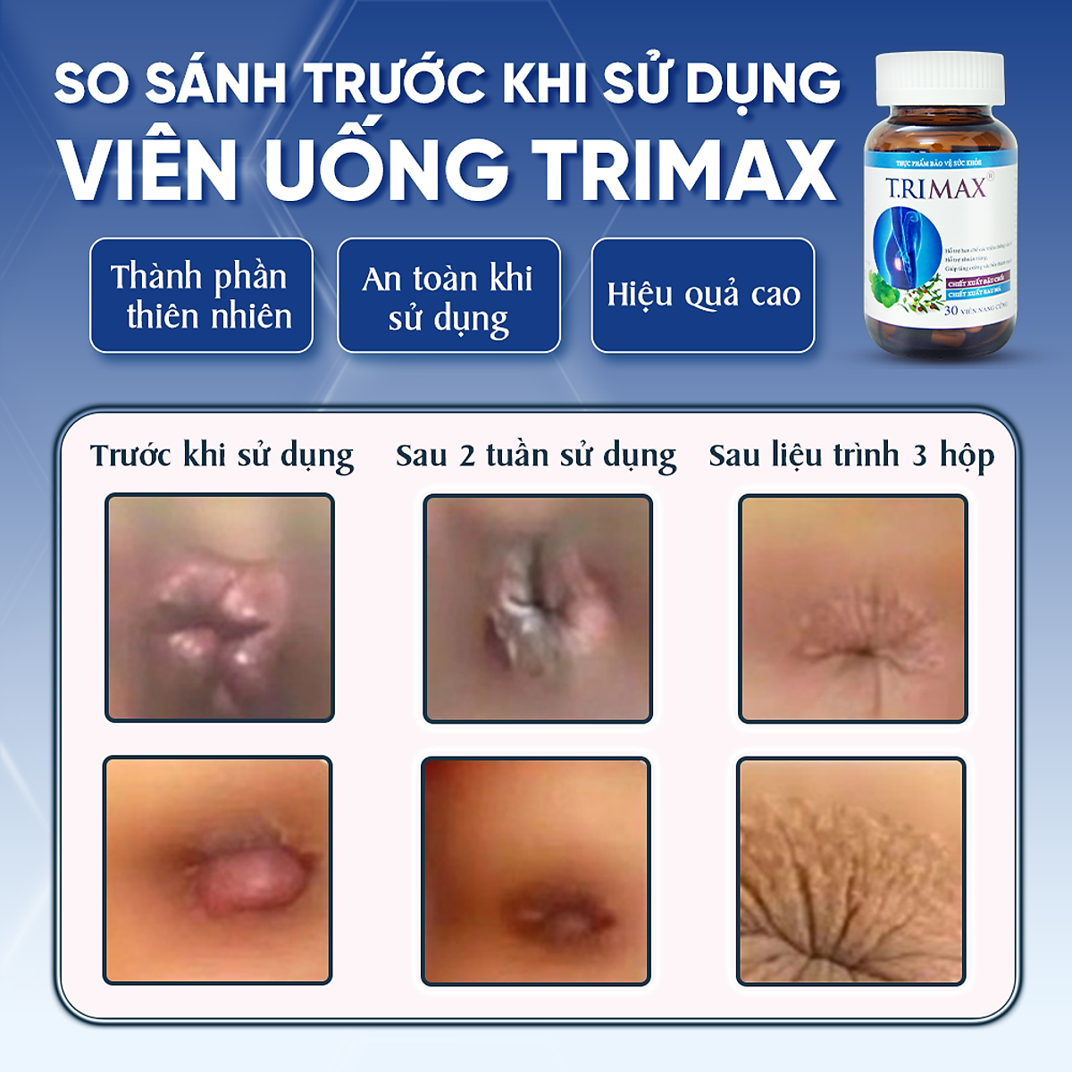 Viên Uống Hỗ Trợ Co Thắt Búi Trĩ Trimax Hủ 30 Viên Nguyên Liệu Từ Thiên Nhiên