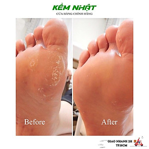 Bộ 3 Dao Lấy Khóe Móng