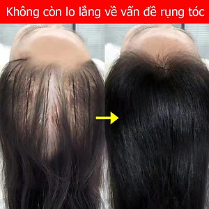 Tinh Dầu Xịt Mọc Tóc EELHOE: Tinh Chất Nhân Sâm và Gừng Tươi Thiên Nhiên Kích Thích Mọc Tóc Sau 7 Ngày Loại Tốt