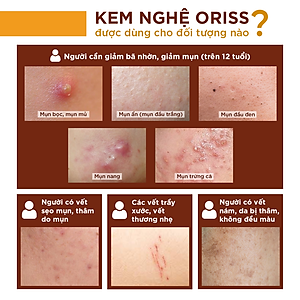 Kem Nghệ Giảm Mụn Oriss Giúp Mờ Thâm Sẹo Dưỡng Ẩm Sáng Da 20g