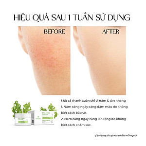 Kem nám và tàn nhang ban đêm Truesky Melasma Cream chiết xuất tảo biển 20g