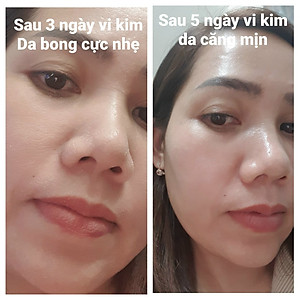 Kem Vi Kim Sinh Học Puderma: Tái tạo da, phá Nám không xâm lấn, không xưng đỏ, hiệu quả sau 3 ngày.