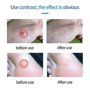 Serum Xóa Mụn Cóc, Mụn Thịt, Nốt Ruồi Hiệu Quả Cao – Thảo Dược Thiên Nhiên, Không Gây Sẹo đèn led