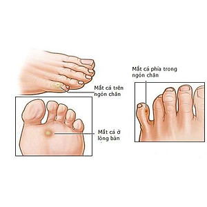 Miếng Dán Mụn Cóc Loại Bỏ Mụn Cóc Tại Nhà An Toàn ( Hộp 6 miếng ) Sản Phẩm Chăm Sóc Cá Nhân Khác