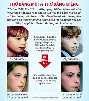 Gói 30 Miếng Dán Chống Há Miệng Khi Ngủ Giảm Ngáy Mouth Seal Băng Dính Miệng Người Lớn Trẻ Em