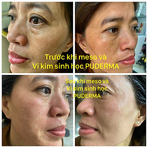 Kem Vi Kim Sinh Học Puderma: Tái tạo da, phá Nám không xâm lấn, không xưng đỏ, hiệu quả sau 3 ngày.