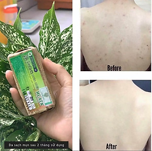 XÀ PHÒNG TRẮNG DA, GIẢM MỤN LƯNG THIÊN NHIÊN MẸ KEN -Giảm sần da, Ngừa mụn lưng, sạch cơ thể