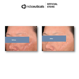 MD:TRANEX RETIPEEL – THAY DA SINH HỌC HỖ TRỢ TRỊ NÁM, SÁNG DA &amp; CHỐNG LÃO HÓA