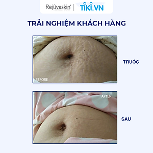 Kem phòng ngừa rạn da và giảm rạn da Rejuvaskin Stretch Mark Cream