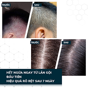 Combo 4 Dầu Gội Đầu Sạch Nấm Da Đầu DEGO PHARMA 80ml - Dứt Điểm Gàu Ngứa & Vảy Nến - Á Sừng