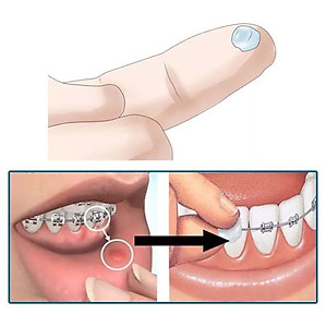 Sáp nha khoa giảm đau khi niềng răng, chỉnh nha - Vitis Orthodontic Wax (Vỉ 2 hộp)