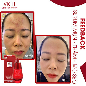 Serum Ngừa Mụn - Thâm - Mờ Sẹo - Kiểm Soát Nhờn VK II ( 15ml/35ml )