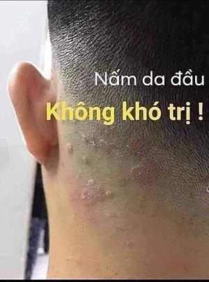 Kem Bôi Nứt Nẻ Á Sừng Tay Chân Ngoài Da - Hàng Nhập Khẩu