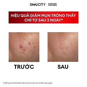 Bộ sản phẩm Men Stay Simplicity chăm sóc da dầu mụn cho nam Acne Relief Skincare Trio: Sữa rửa mặt 100g x Serum 30ml x Kem dưỡng ẩm 80g