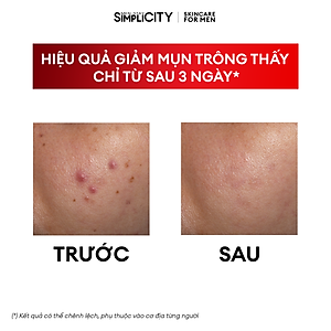 Serum Men Stay Simplicity cho da mụn giúp làm dịu, khô cồi cho nam Calm Skin Relief Facial Serum 30ml